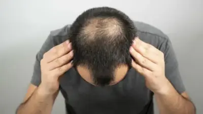 7 dicas essenciais para quem está lidando com a calvície