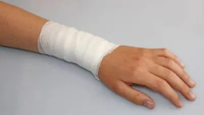 Veja como funciona método inovador para curar queimaduras
